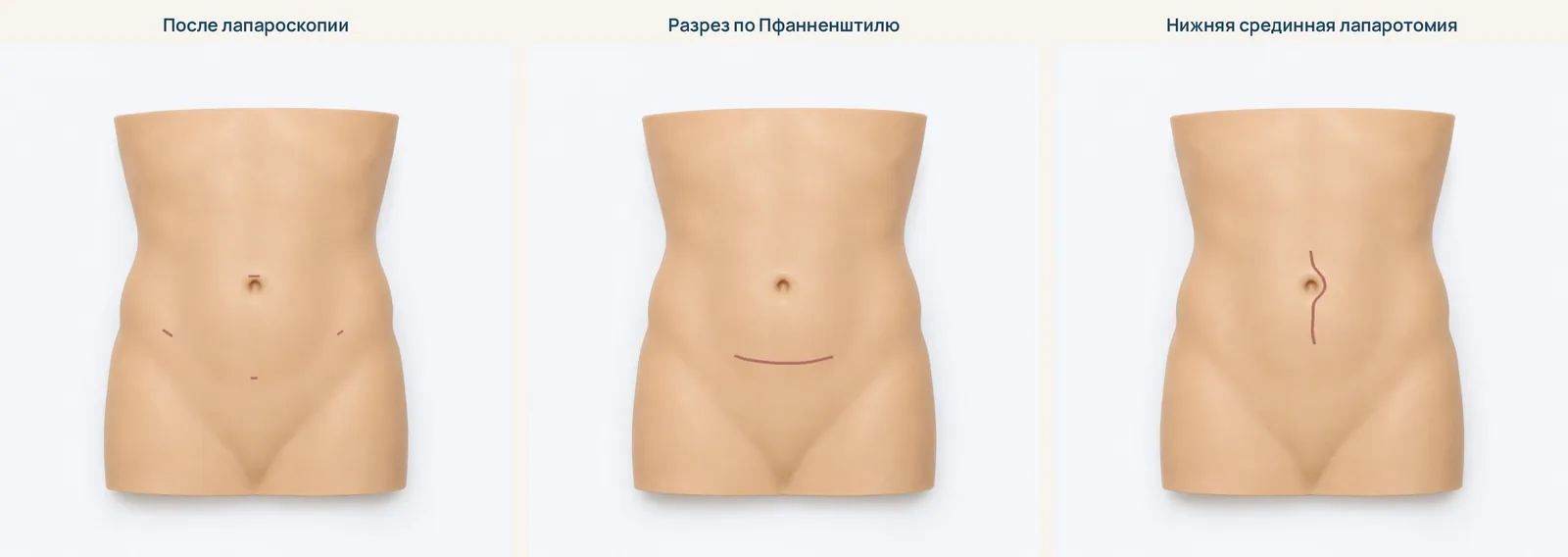 Слева — следы после лапароскопии. В центре — разрез по Пфанненштилю (поперечный разрез над лобком). Справа — нижняя срединная лапаротомия (продольный разрез)