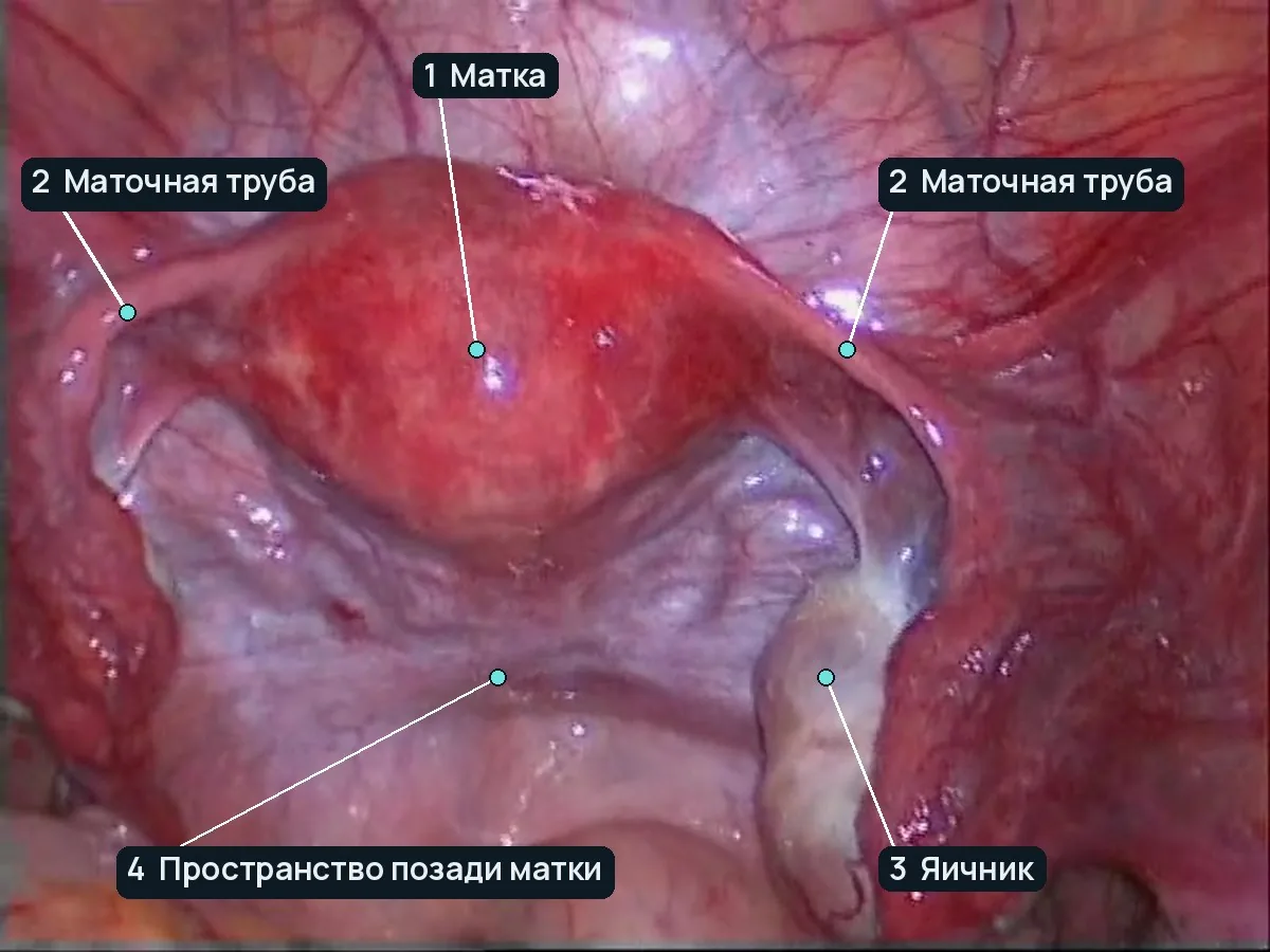 Кадр из видео: нормальная анатомия малого таза, вид через лапароскоп