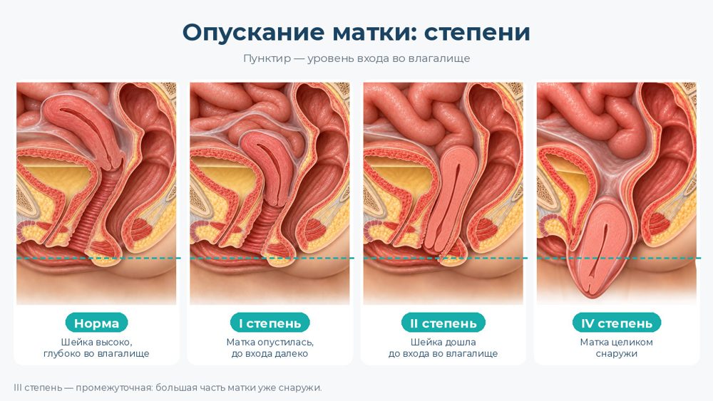 Степени опущения матки относительно входа во влагалище (пунктир)
